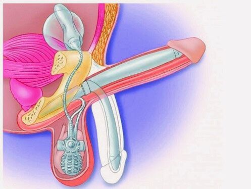 Penis enlargement by penile prosthesis