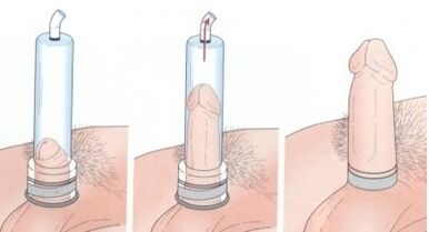 Penis enlargement with a pump